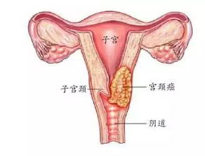 这个常见病,只需三步就可以让你患上 宫颈癌 