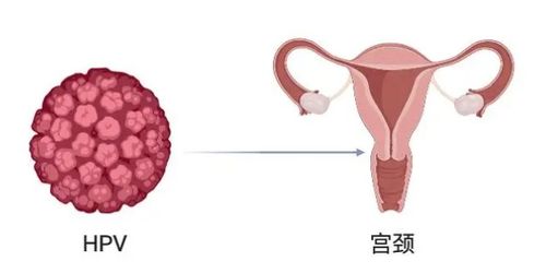 HPV病毒感染是宫颈癌致病因素,专家提醒宫颈癌早期治疗是关键