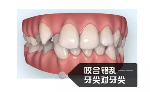 半口矫正省钱又省事儿,我可以做吗