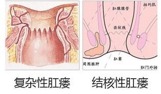 肛瘘治疗方法哪种最好 肛瘘的极佳治疗方法是什么