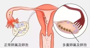 多囊卵巢综合征的临床表现有(多囊卵巢综合征的临床表现有哪些)