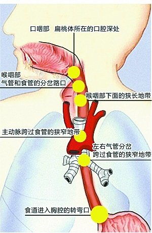 鱼刺卡喉，提醒朋友鱼刺卡住的朋友圈