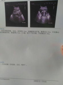 孕五月的b超图 生日2016年02月宝宝圈 