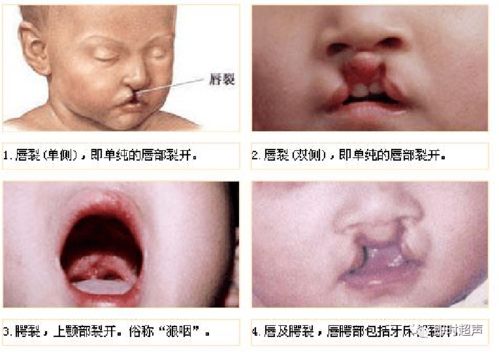 细节感人 多图全面解读 常见5类胎儿畸形超声诊断及处理