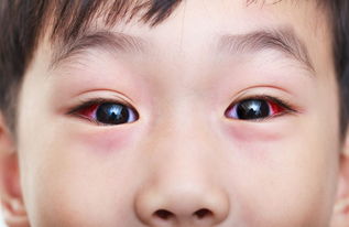 5岁孩子游泳,全家6口染病 青岛家长注意 夏季 红眼病 高发,传染性极强 