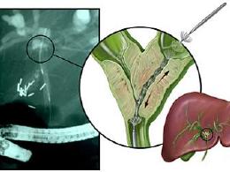 胆管癌的原因 胆管癌是什么引起的 胆管癌的病因 胆管癌是怎么回事 
