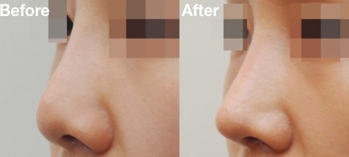 鼻尖用耳部软骨改造形状后获得的效如何