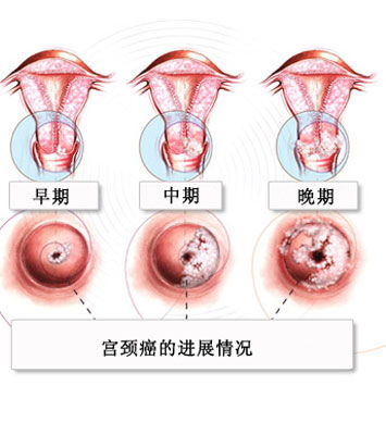 宫颈癌出血特点 宫颈出血是什么症状