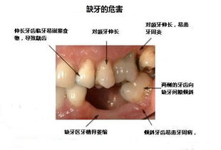 种牙好不好