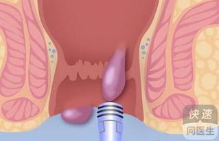 内痔脱出的症状是什么 针对症状治疗效果更好