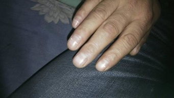 手指甲压伤后,怎么判断是甲床是否坏了 指甲根部肿了,整个指甲变黑了,还能长出新指甲吗 
