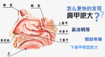 鼻甲肥大有四种方法有效缓解疼痛