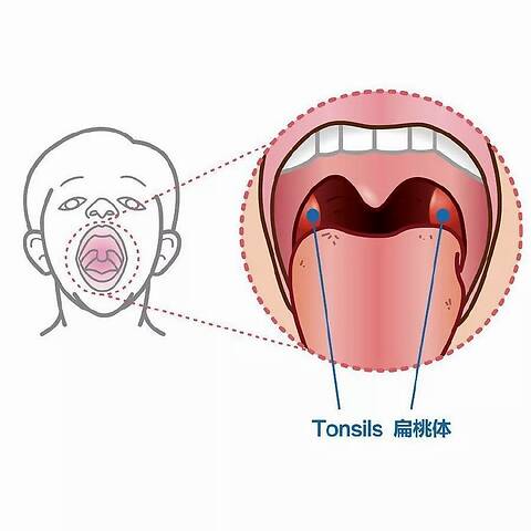 扁桃體結石在哪裡圖解 - 搜狗圖片搜索