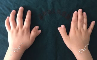 温州五岁小男孩双手演绎 六指琴魔 ,医生妙手让其 伸手见五指