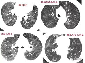 肺部磨玻璃结节的治疗方法有哪些(肺部磨玻璃结节的治疗方法有哪些药)