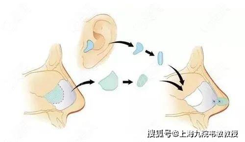 九院韦敏教授丨耳软骨隆鼻的吸收率,可能受到哪些因素影响