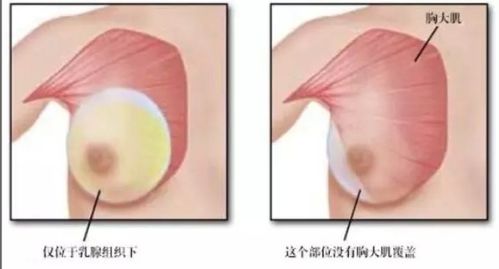 北京隆胸手术注意事项,读一文而了全貌 乳腺 