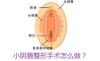 什么情况需要做小阴唇整形术