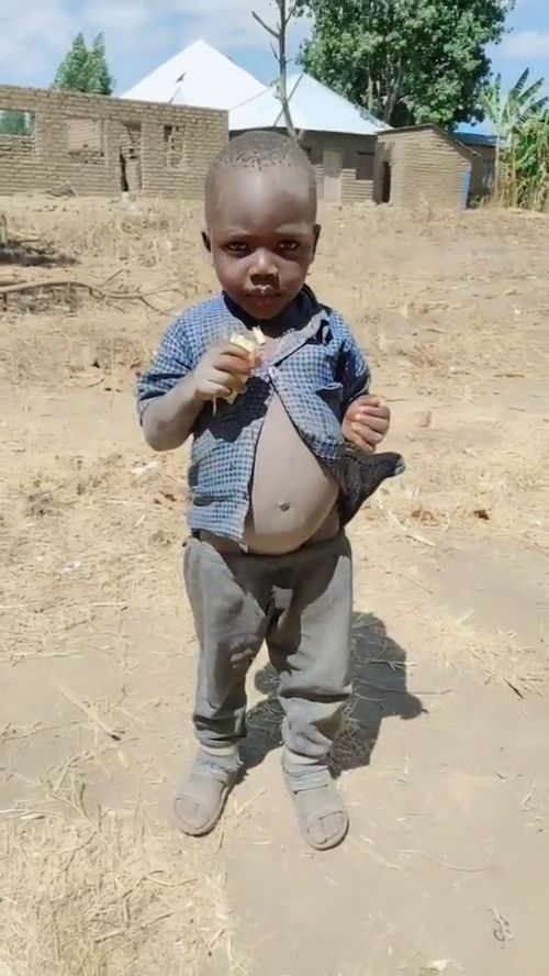 非洲的孩子吃饭没营养,玉石肚子就变成了这样,网友 跟怀孕一样 
