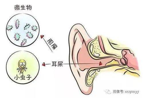 掏耳朵一时爽,一直掏耳朵......