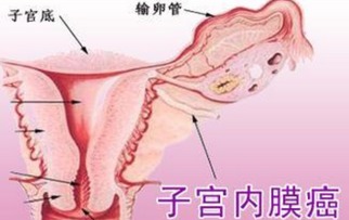 普及子宫内膜癌术后的饮食原则 