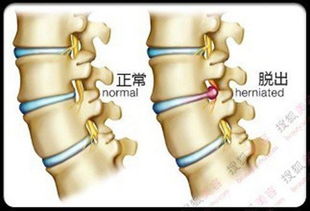 双脉冲钬激光切除椎间盘突出手术只要8毫米切口 