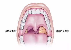 宝宝扁桃体发炎是什么原因引起的