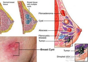 如何保守治疗乳腺囊肿