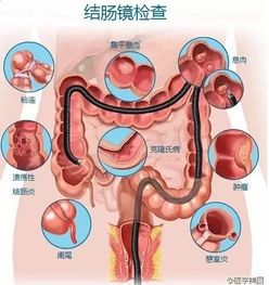 如何判断要不要做胃肠镜检查