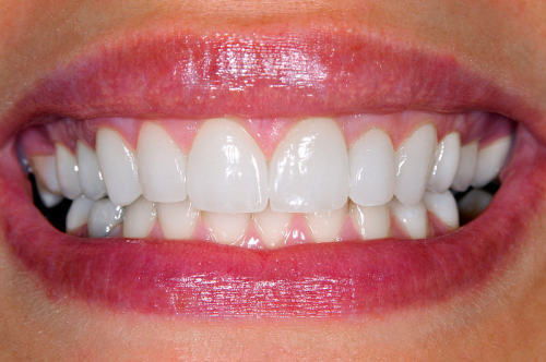 牙齿美白怎么样 时代潮流的象征,早已不是肤白貌美,美牙你准备好了吗