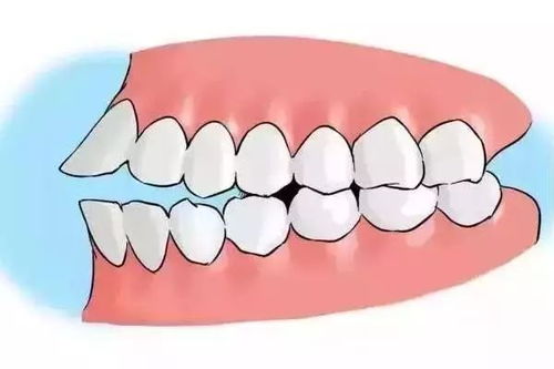 牙不齐影响发音 吞咽 呼吸,你还认为牙齿矫正可以不做 