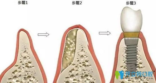 种牙齿填骨粉的利弊和不植骨种牙的后果分析