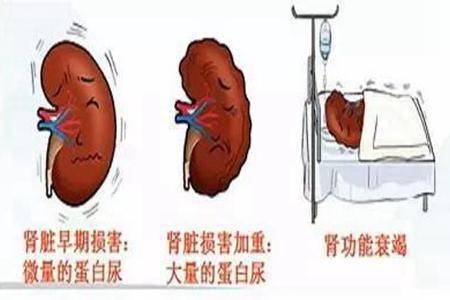 痛风石并不可怕,可怕的是你一无所知