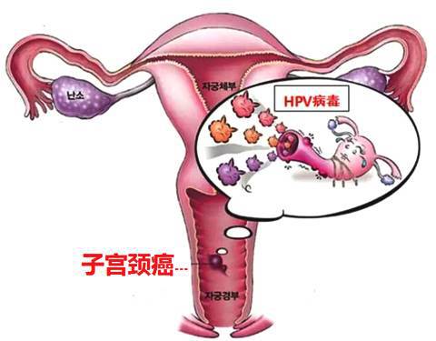 有hpv病毒的女人不要怕,做一件事让HPV自愈,不再担心宫颈癌