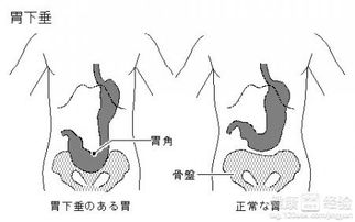 胃下垂吃什么有效