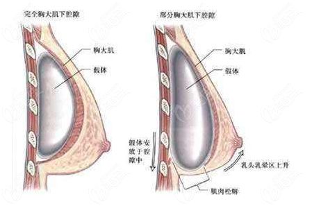 做完假体隆胸会不会感觉胸很重呢 还会有其它什么影响吗