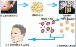 自体脂肪填充脸部的风险 自体脂肪填充注意事项