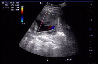 怀孕4个月胎儿b超图？这是4个月的b超单,请大家帮你看看是男孩还是女孩,谢了