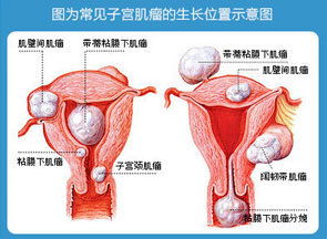 静康医院于萍 让女性不孕和流产的子宫肌瘤