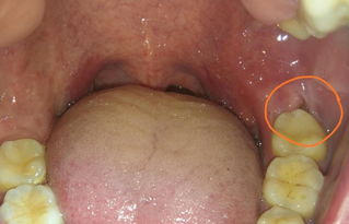 发现智齿蛀牙,需要拔掉吗 医生提醒 别犹豫了