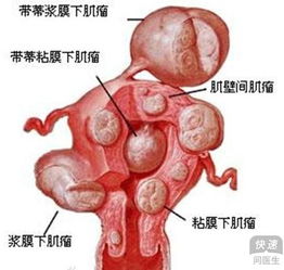 子宫肌瘤会发生在哪些部位呢 四类子宫肌瘤详解