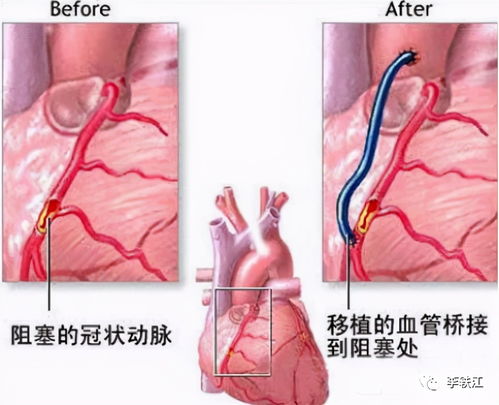 心脏边上的血管破裂了能做手术吗我的妈妈(心脏边上的血管破裂了能做手术吗我的妈妈是谁)