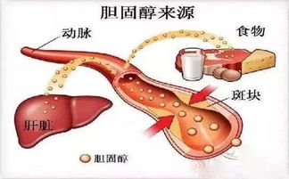 胆固醇偏高怎么回事 日常做到这几点,不吃药也能降低胆固醇 