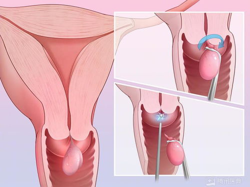 宫颈为何这么爱生病 女生最该了解的6个知识