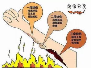 宝宝被烧烫伤了,学习正确的紧急处理方法