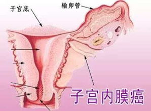 子宫内膜癌早期