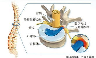 不花钱,不吃药,每天仅需3分钟轻松摆脱十来年的腰间盘突出