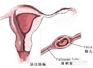 阴道出血是怎么回事