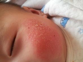 婴儿湿疹会引起湿疹吗,婴儿湿疹怎么引起的