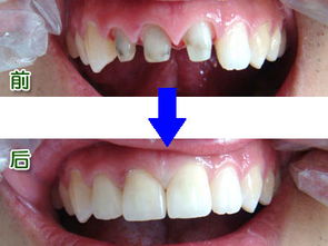 缺损的牙齿可以用烤瓷牙来修复吗